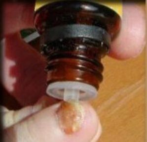 Εφαρμογή σταγόνων σε ένα νύχι που έχει προσβληθεί από μύκητες